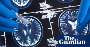Scientists claim that they could potentially diagnose brain tumors within hours, according to their research in the field of cancer studies.