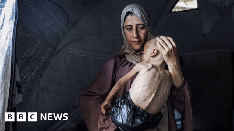 Distressed parent of famished infant gives interview to BBC.