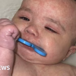 The Spread of Measles: North America’s Epidemic Hinges on Canada