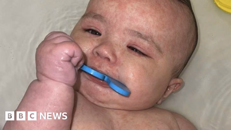 The Spread of Measles: North America’s Epidemic Hinges on Canada
