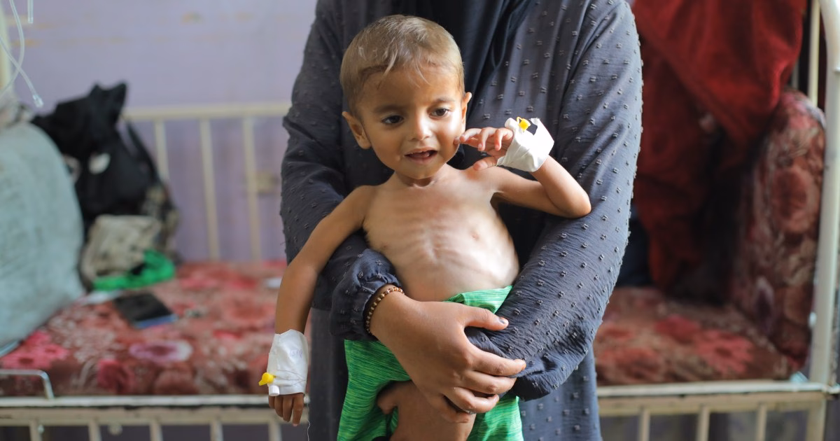 Aa 20250813 38815916 38815902 malnourished gaza children treated with limited medical resources 1755.jpeg
